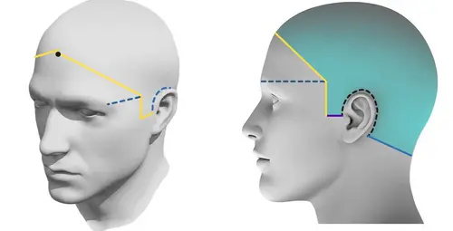 Neuralgia del nervio mandibular