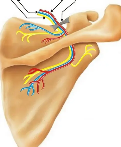 Neuralgia del nervio supraescapular