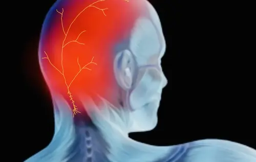 Neuralgia Occipital