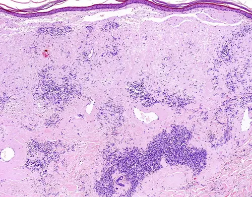 Neuropatía Amiloide Relacionada con el Depósito de Proteínas Amiloides