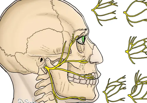 Neuropatía del nervio facial