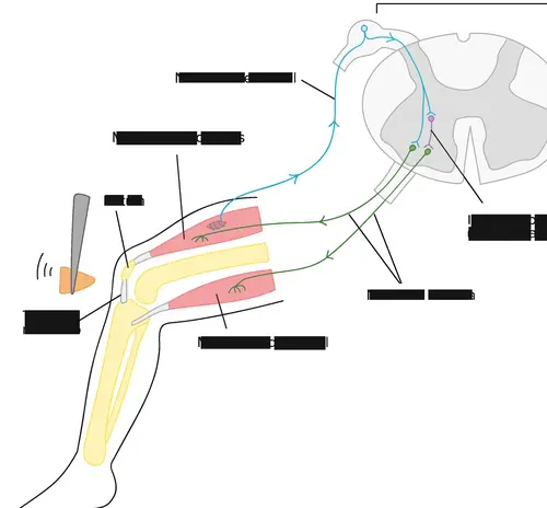 Neuropatía Motora Pura que Afecta Solo los Nervios Motores