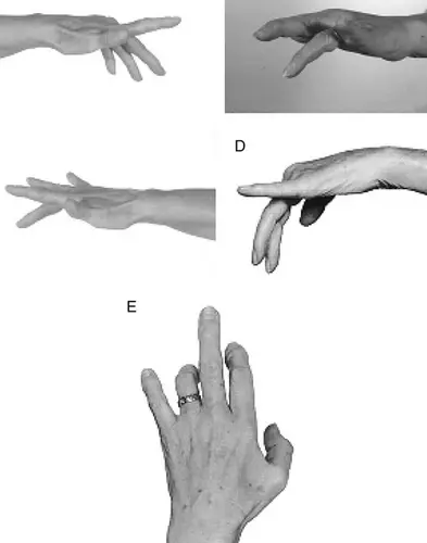 Neuropatía motora