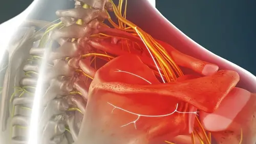 Neuropatía por atrapamiento del nervio genitofemoral