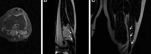 Neuropatía por Atrapamiento del Nervio Peroneo