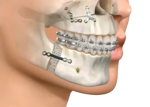 Neuropatía por cirugía dental que afecta la mandíbula