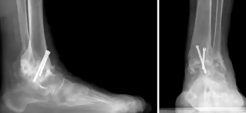 Neuropatía por cirugía o lesión en el tobillo