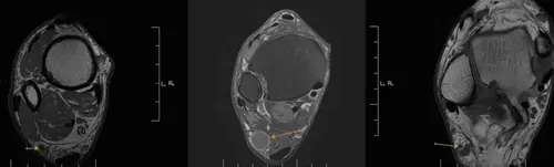 Neuropatía por compresión del nervio digital en los dedos