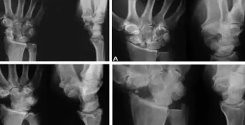 Neuropatía postraumática de la muñeca