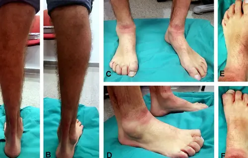 Neuropatía Postraumática de la Pierna