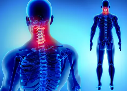 Radiculopatía cervical