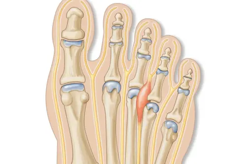 Síndrome de Morton o Neuroma de Morton