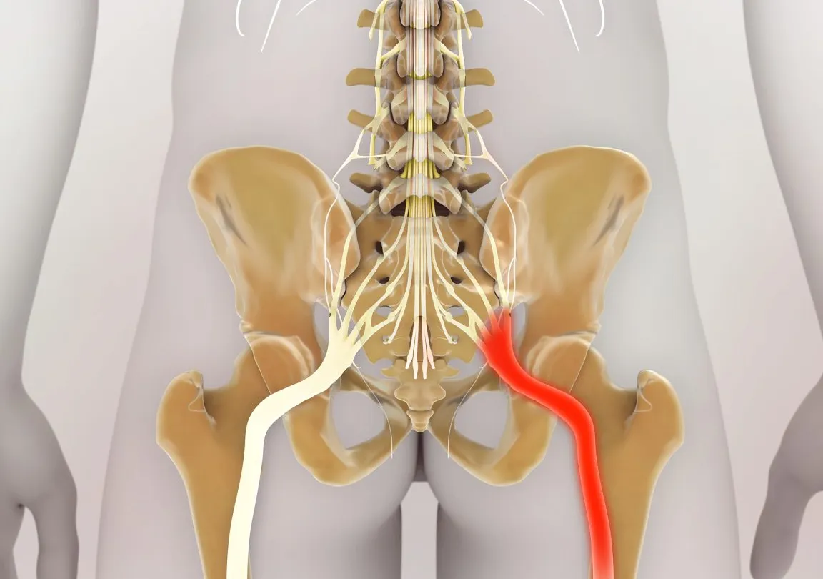 Neuralgia del nervio ciático: Causas, Síntomas y Tratamientos