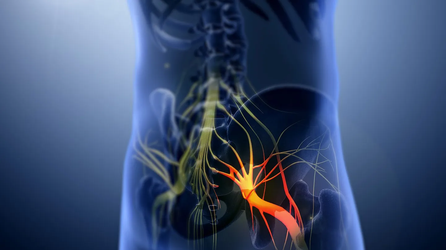  Causas de la Neuralgia del Nervio Ciático 