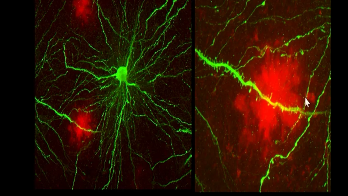 ¿Qué es la neuropatía amiloide?