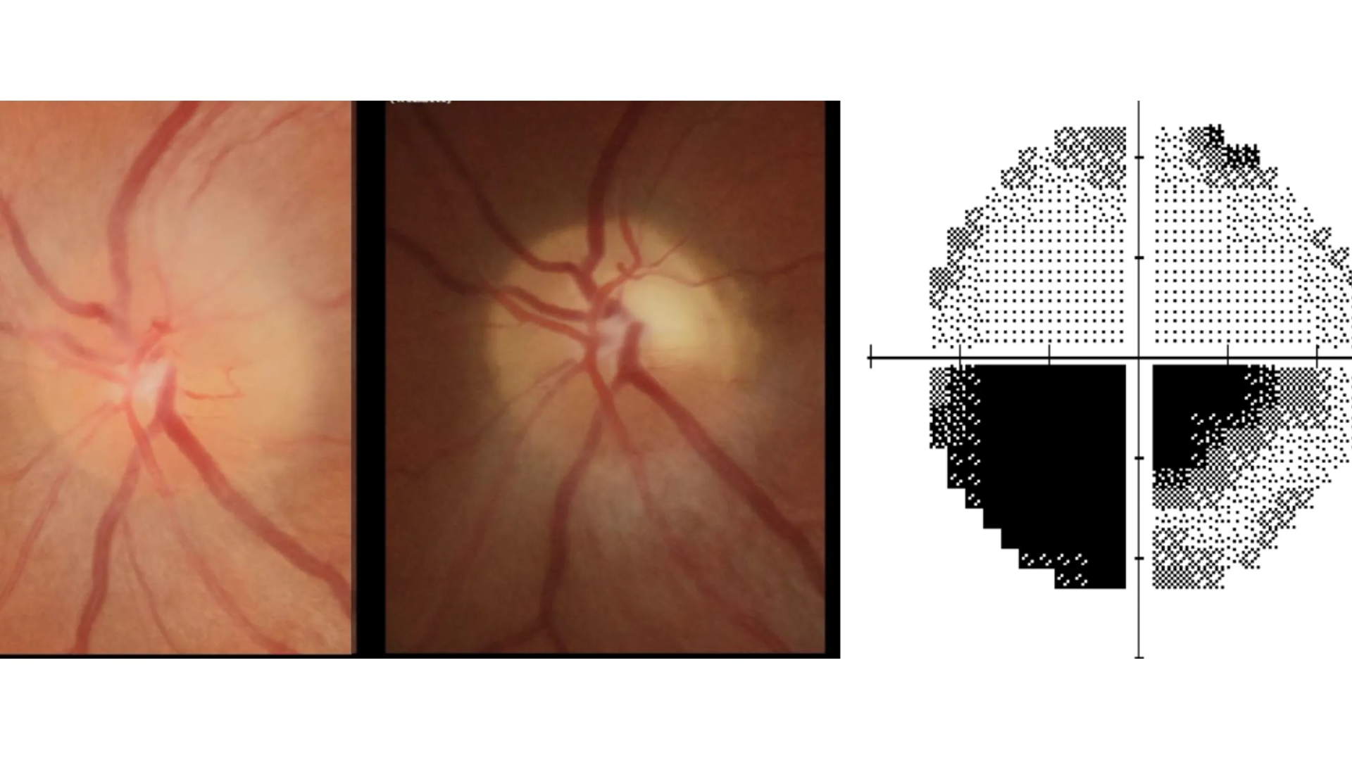 Neuropatía del nervio óptico: Causas, Síntomas y Tratamientos Efectivos