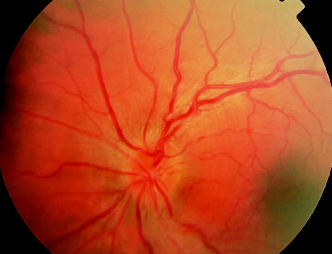 Síntomas de las Neuropatías Hereditarias