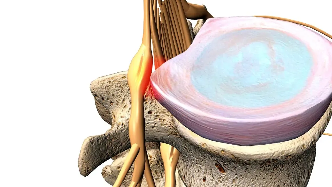 Neuropatía Lumbar por Compresión de Raíces Nerviosas