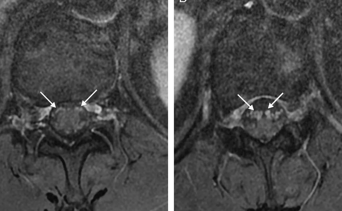 ¿Qué es la neuropatía lumbar por compresión de raíces nerviosas?