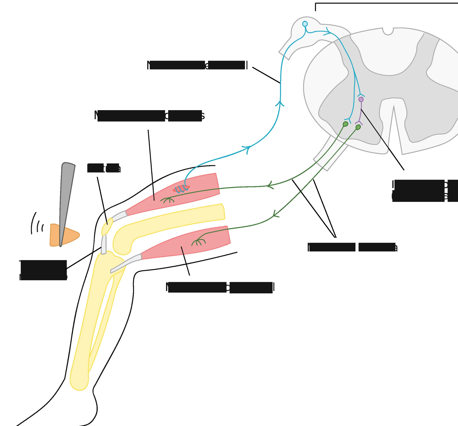 Neuropatía Motora Pura que Afecta Solo los Nervios Motores