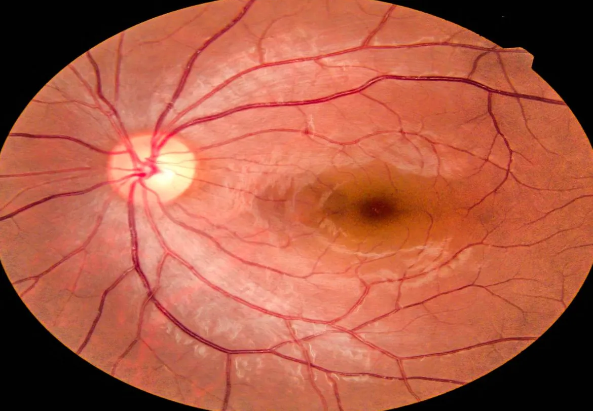 Neuropatía Ocular