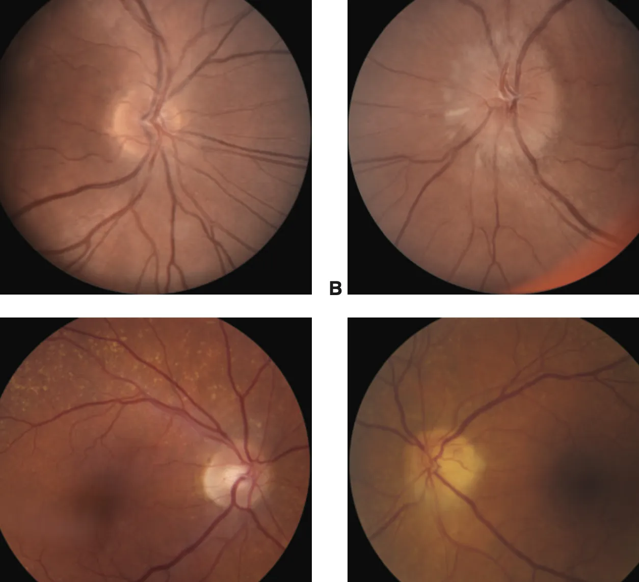 Causas Comunes de la Neuropatía Ocular