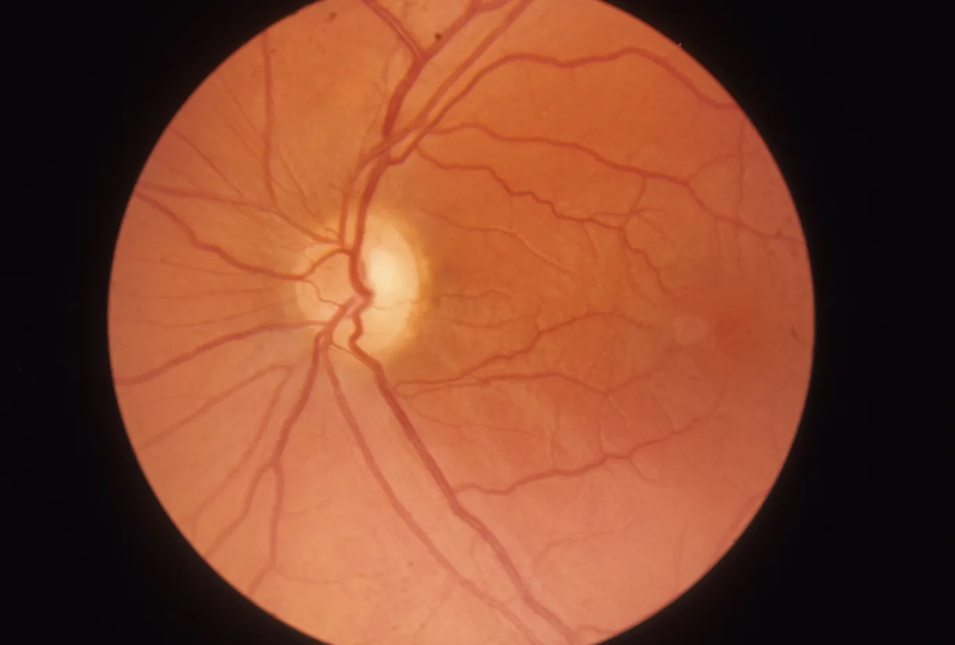 Reconociendo los Síntomas de la Neuropatía Ocular