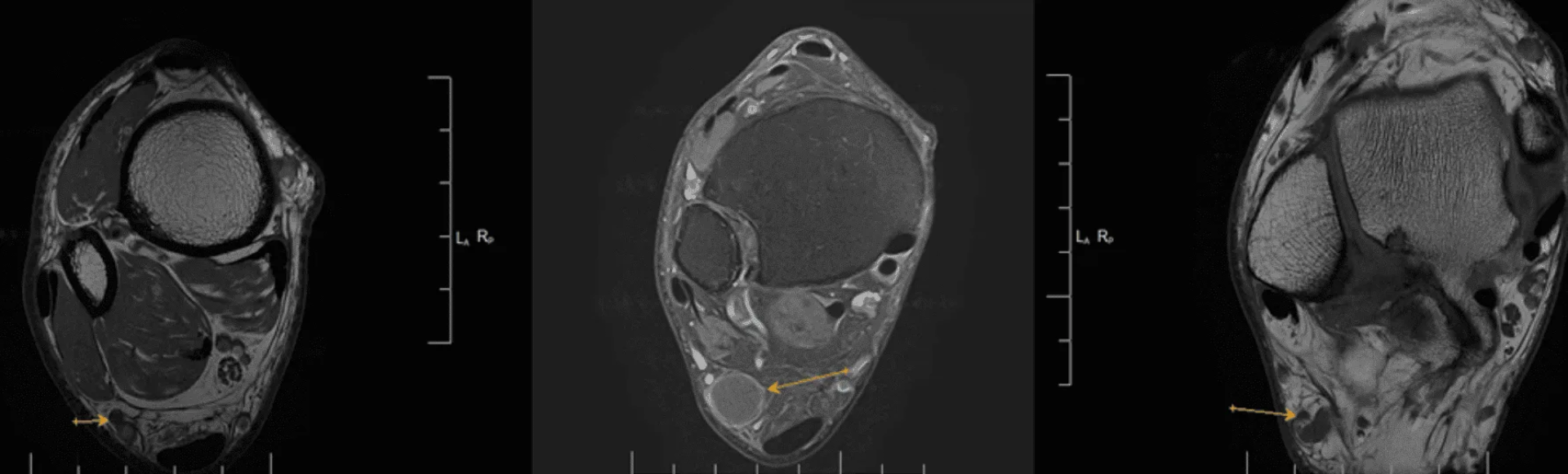 Opciones de Tratamiento para la Neuropatía en el Suelo Pélvico