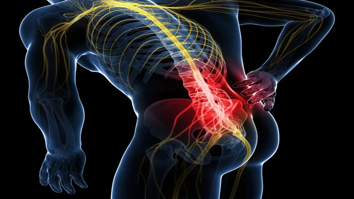 Neuropatía por atrapamiento del nervio ciático