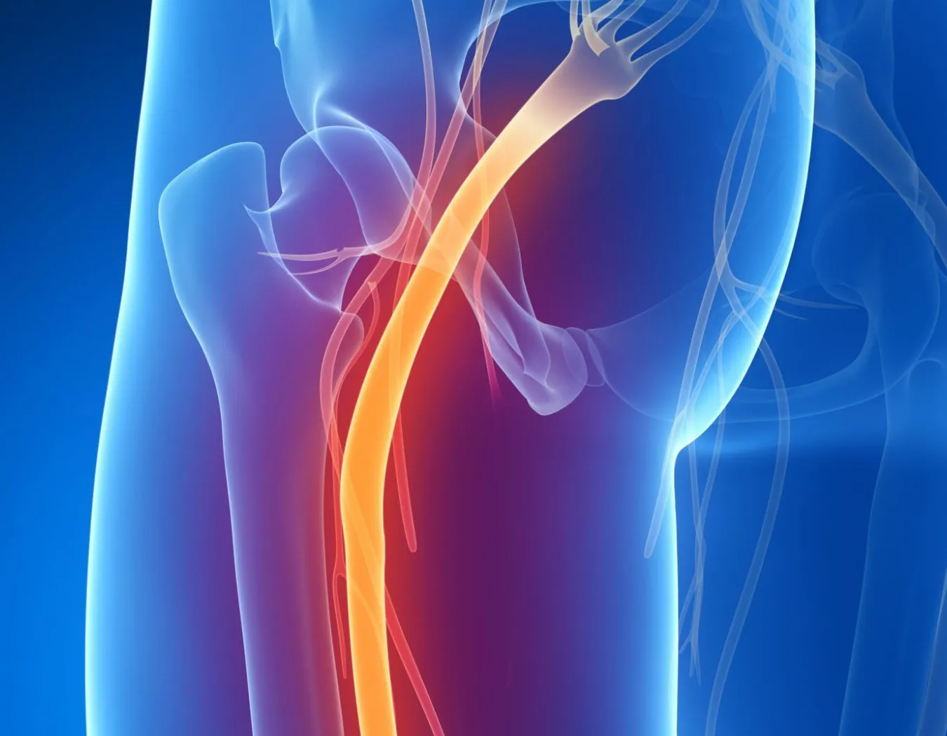 Neuropatía por atrapamiento del nervio ciático