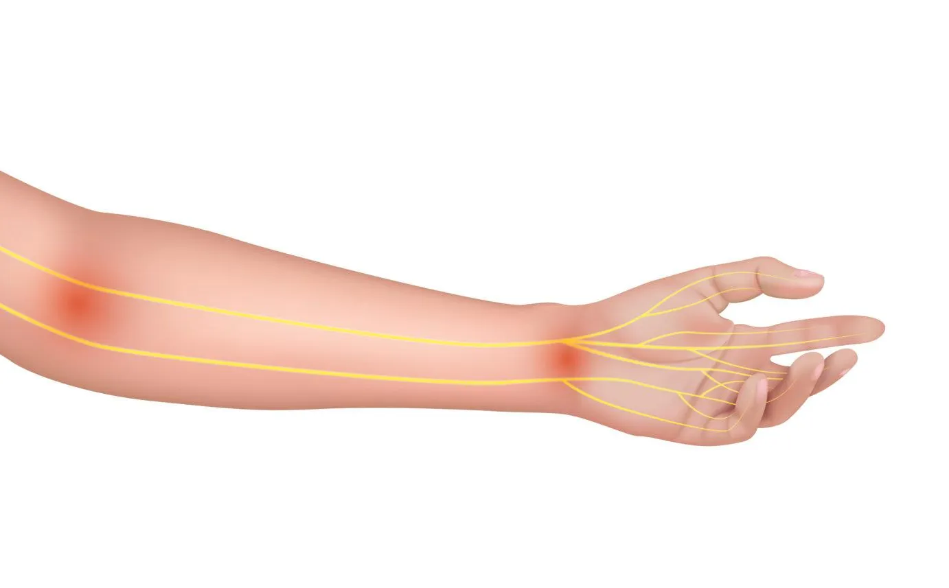 Entendiendo la Neuropatía por Atrapamiento del Nervio Mediano