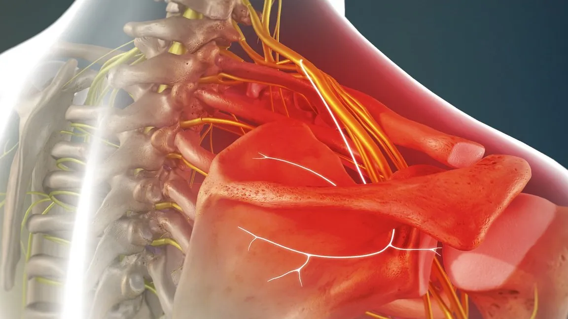 Neuropatía por atrapamiento del nervio supraescapular