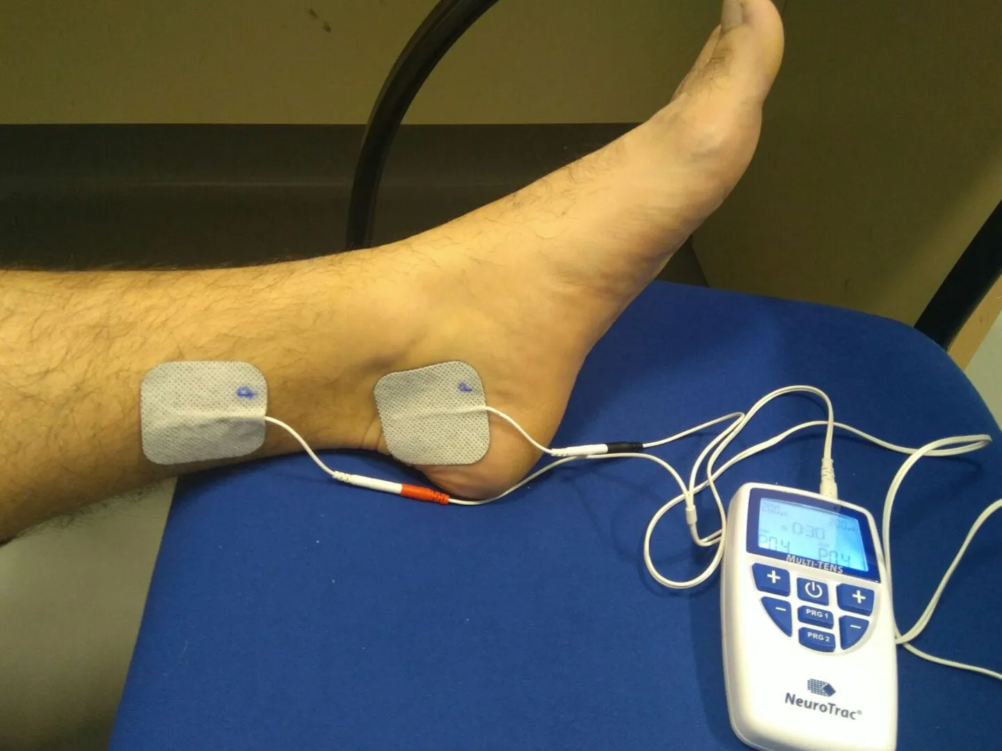 Neuropatía por Atrapamiento del Nervio Tibial Posterior