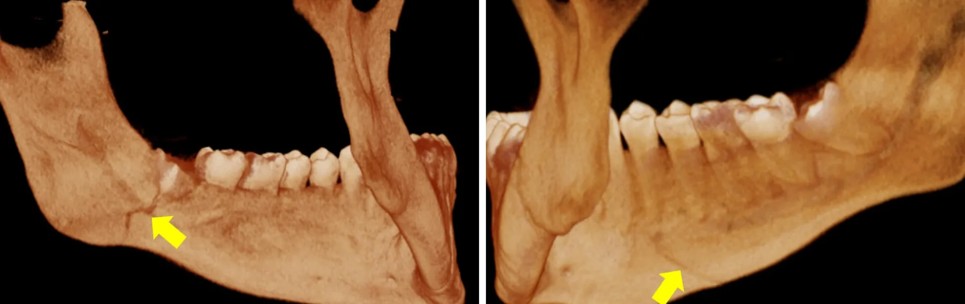 Neuropatía por cirugía dental que afecta la mandíbula