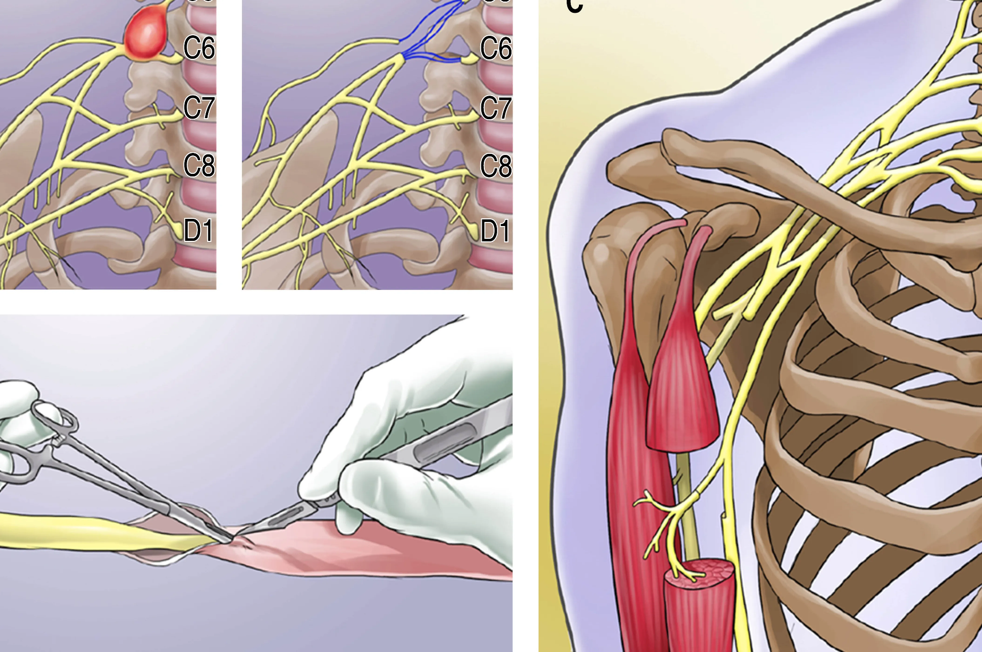 Comprender la Neuropatía por Compresión del Plexo Braquial que Irradia al Pecho