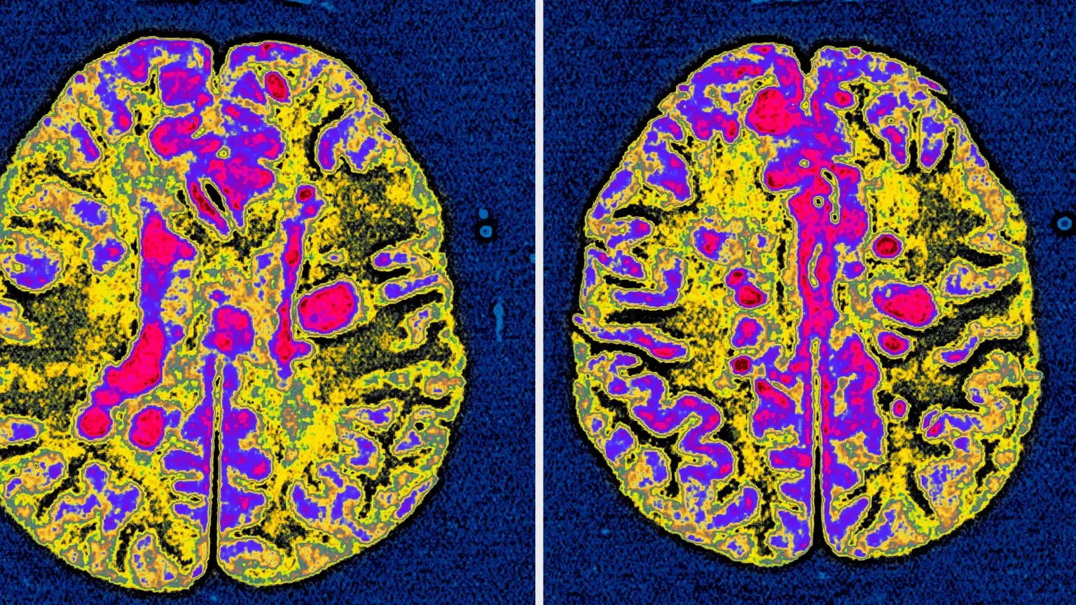 Diagnóstico de la neuropatía en pacientes con esclerosis múltiple