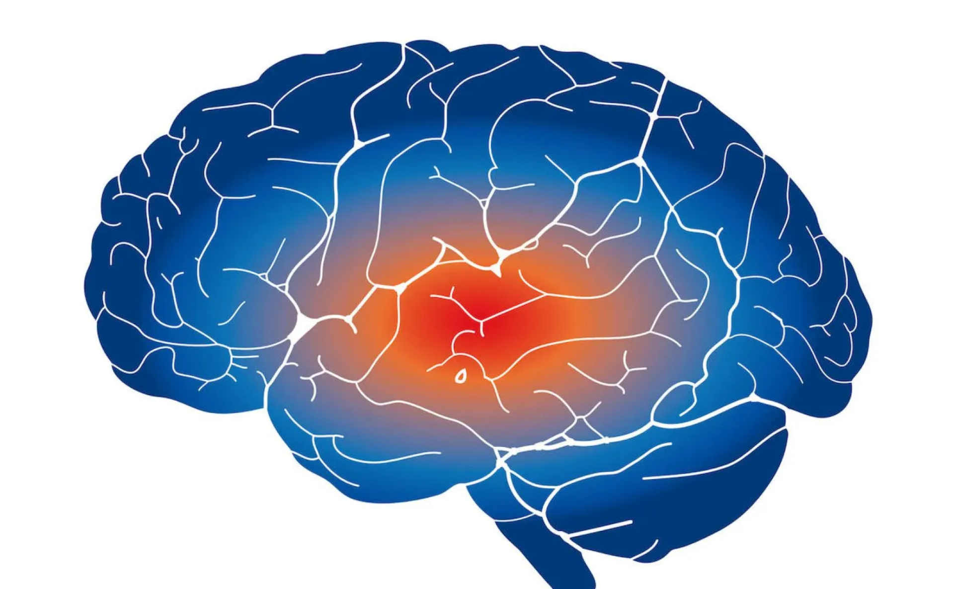 Abordando el tratamiento de la neuropatía por esclerosis múltiple