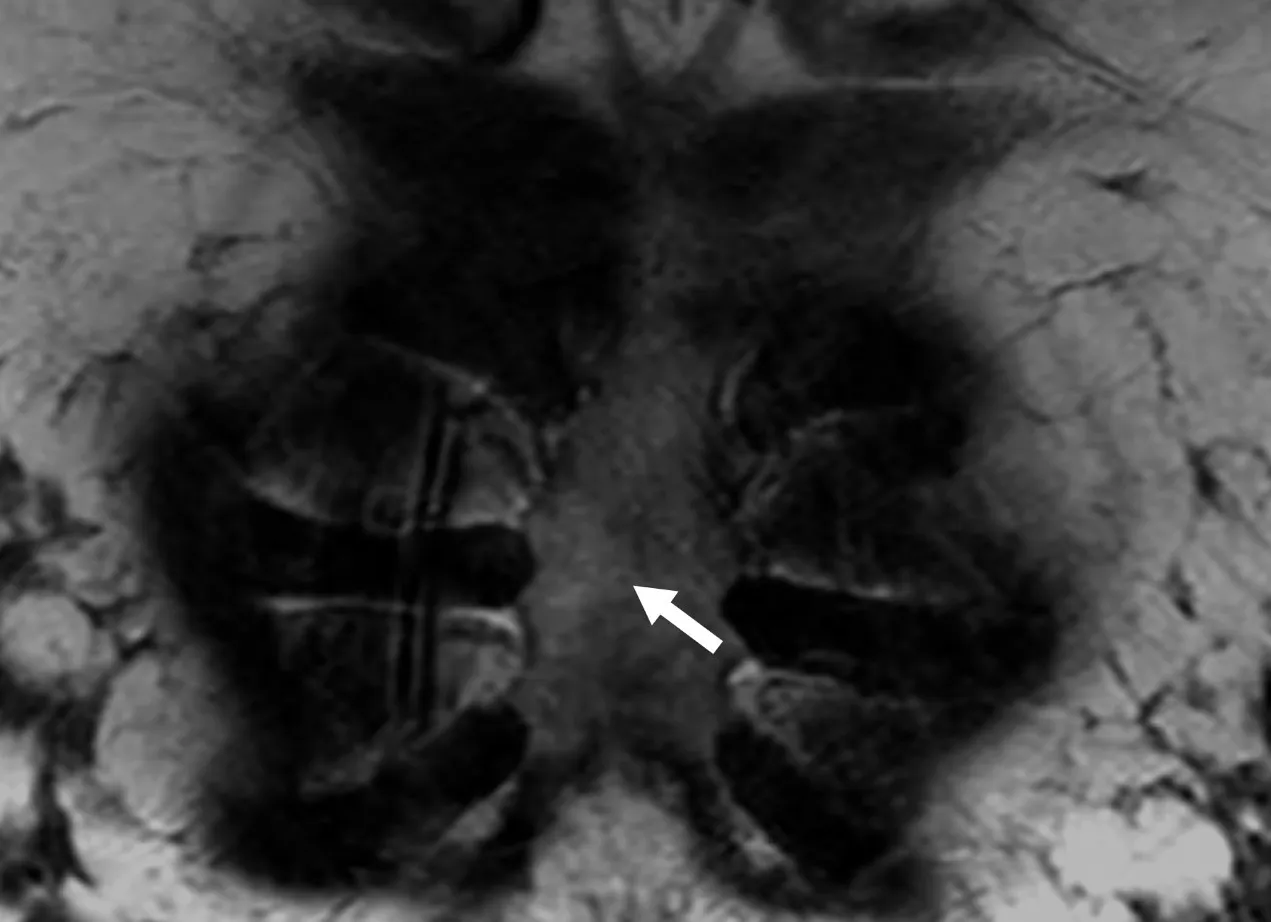 Síntomas de la neuropatía por el Síndrome de Tietze