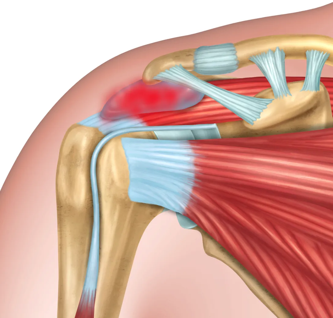 Introducción a la Neuropatía Postraumática del Hombro