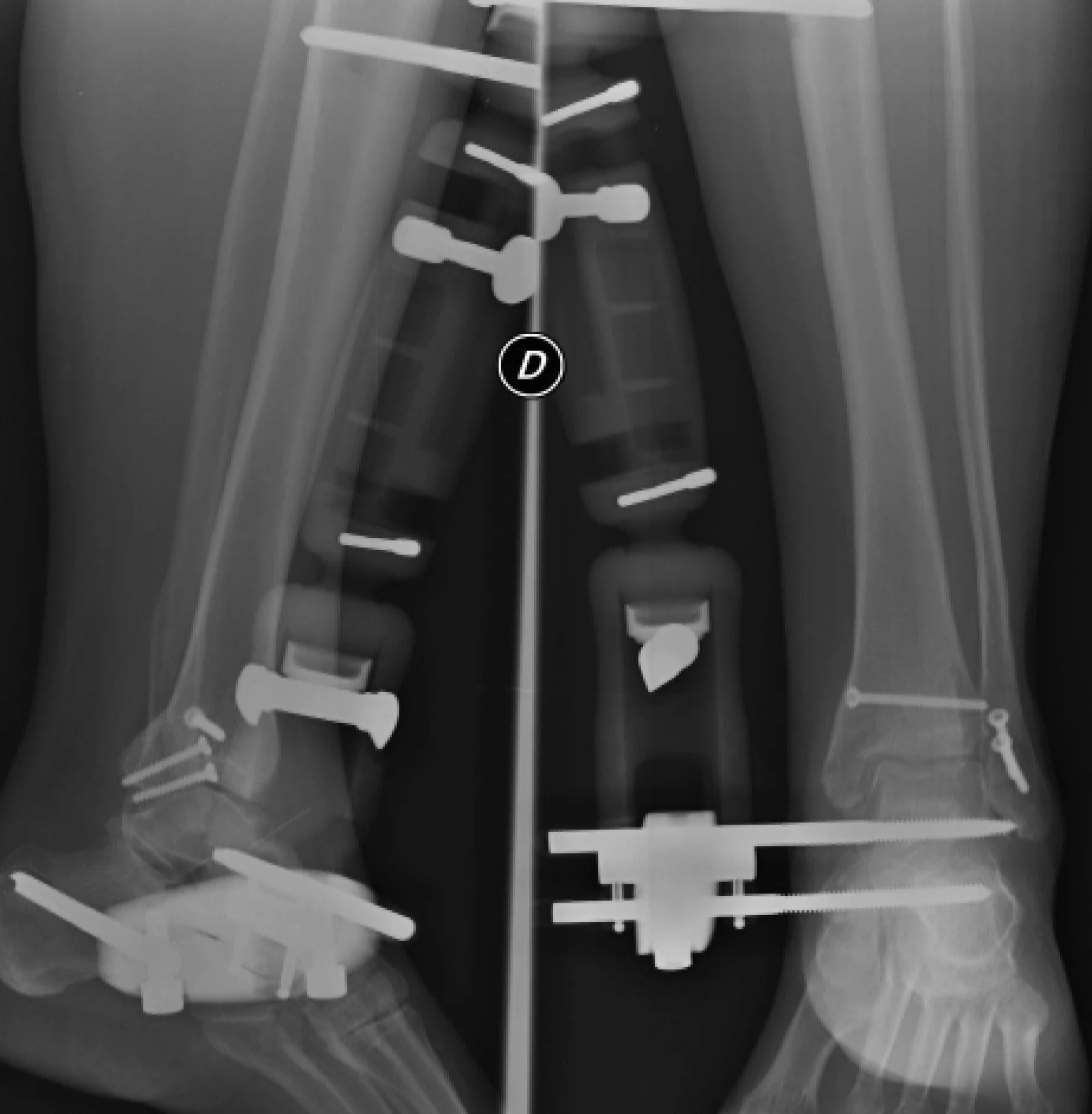 Introducción a la neuropatía postraumática del tobillo