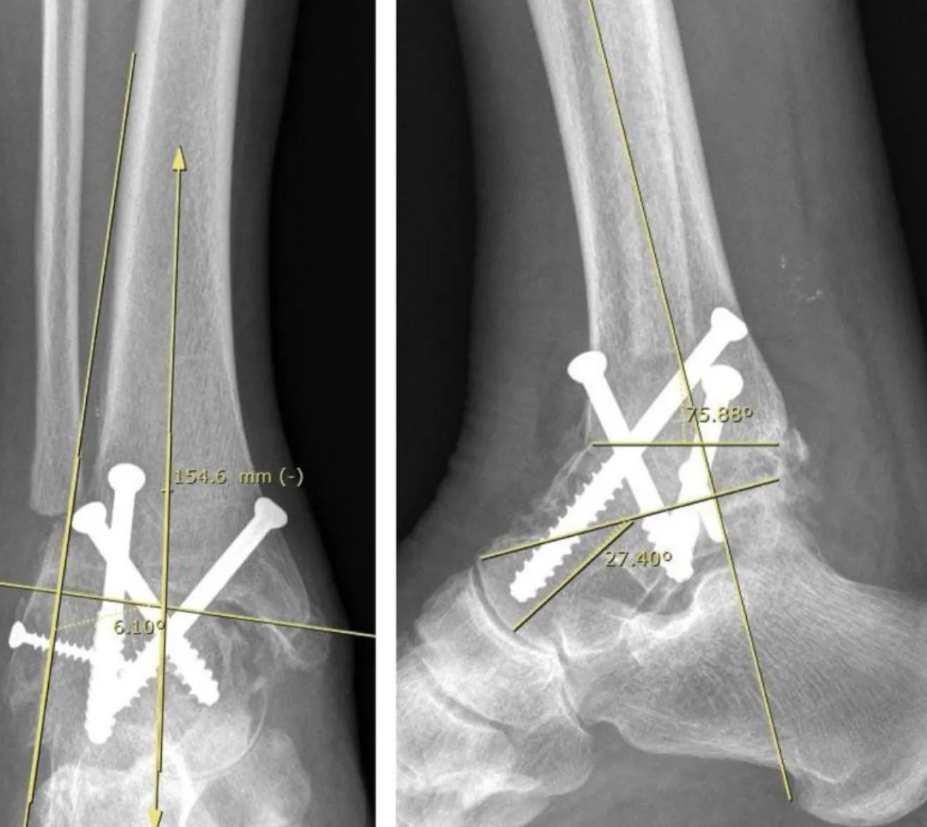 Cuáles son los síntomas comunes de la neuropatía postraumática del tobillo