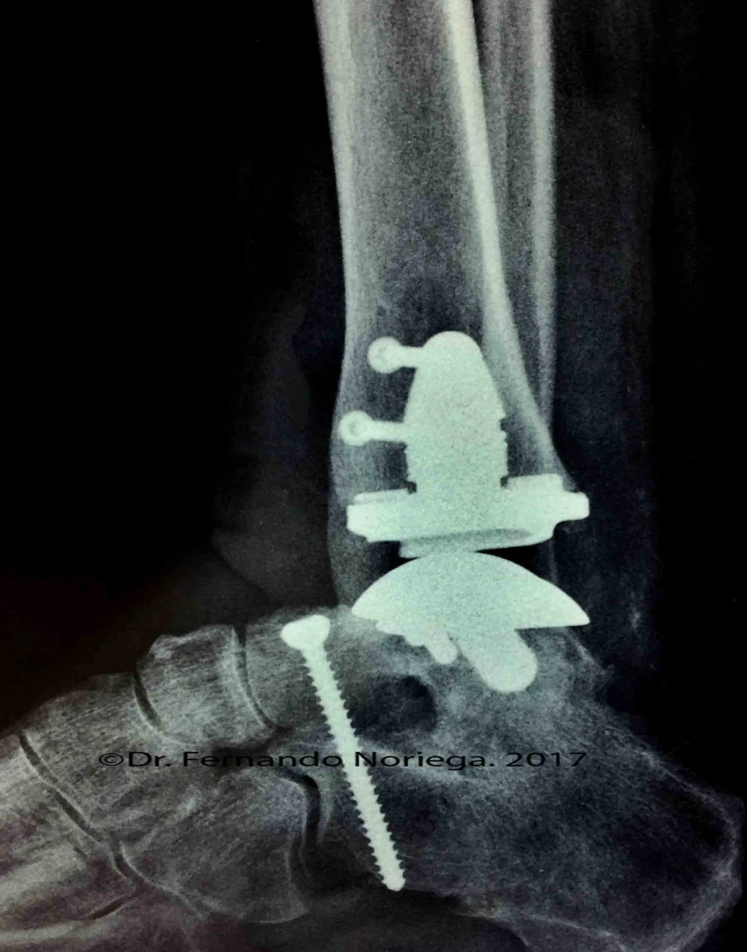 Tratamientos efectivos para la neuropatía postraumática del tobillo