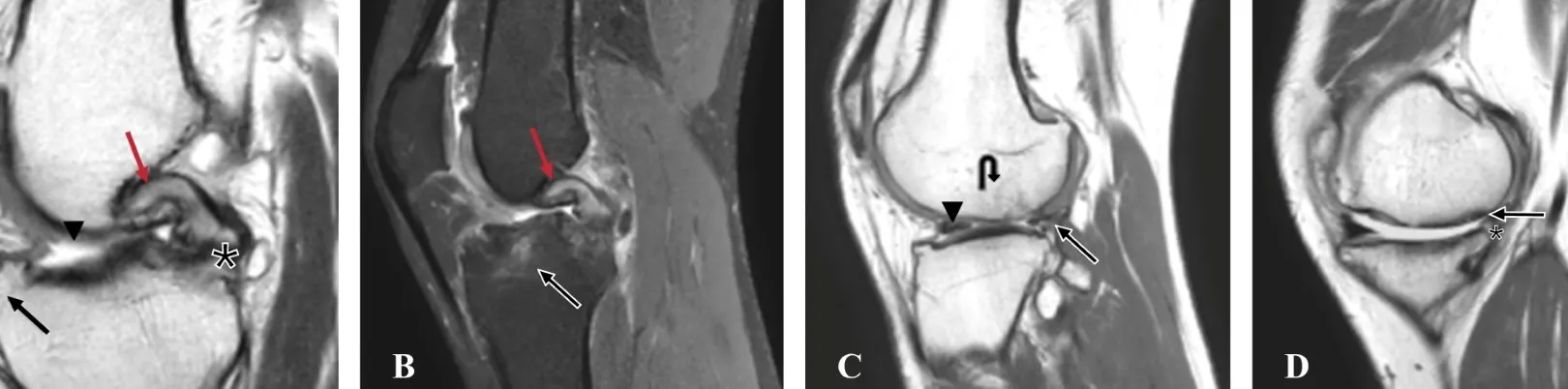 Explora las Causas de la Neuropatía Postraumática en el Cuello