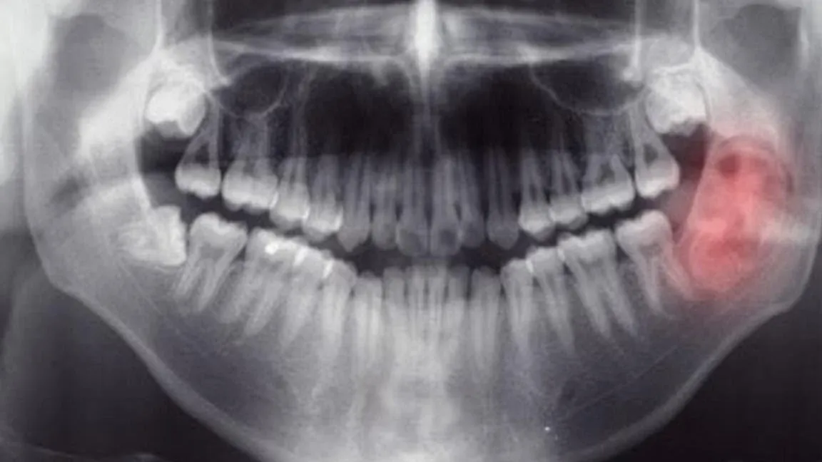 Neuropatía postraumática de la mandíbula