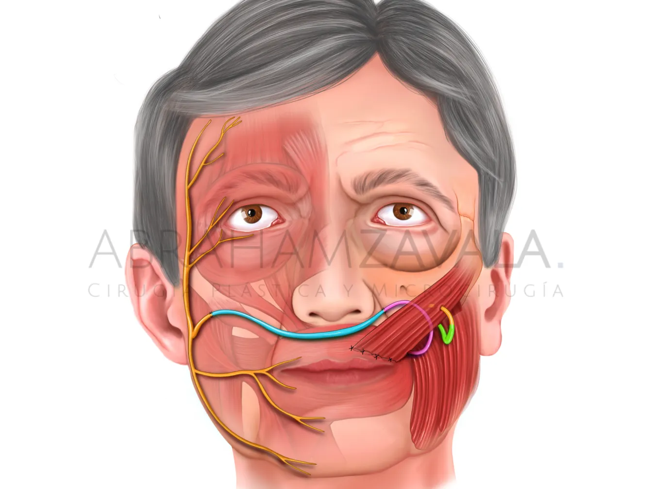 Parálisis facial o muscular