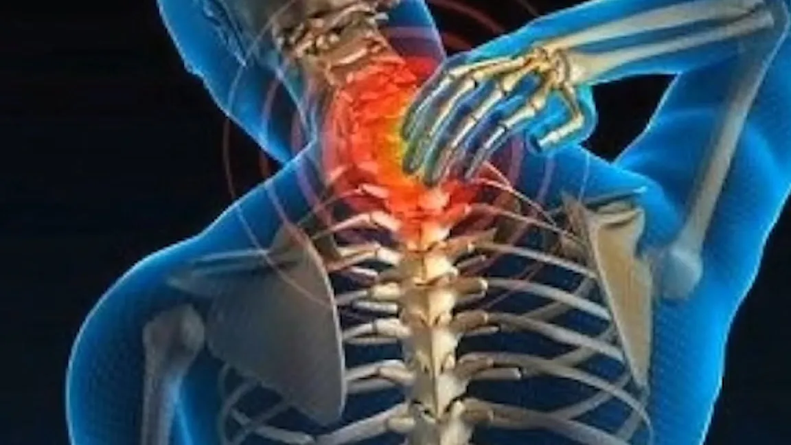 Comprende la Radiculopatía Cervical y sus Efectos