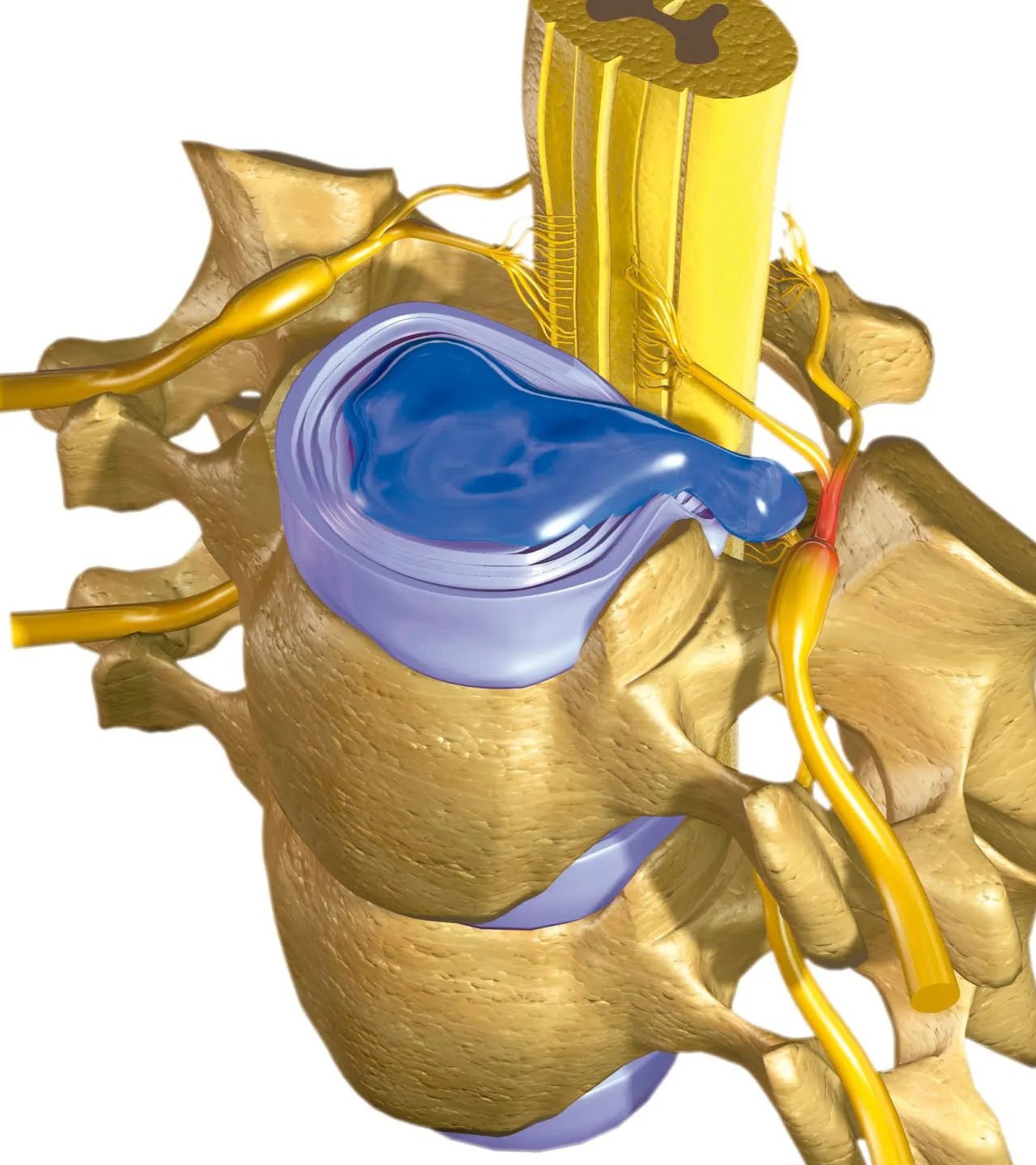 Radiculopatía cervical