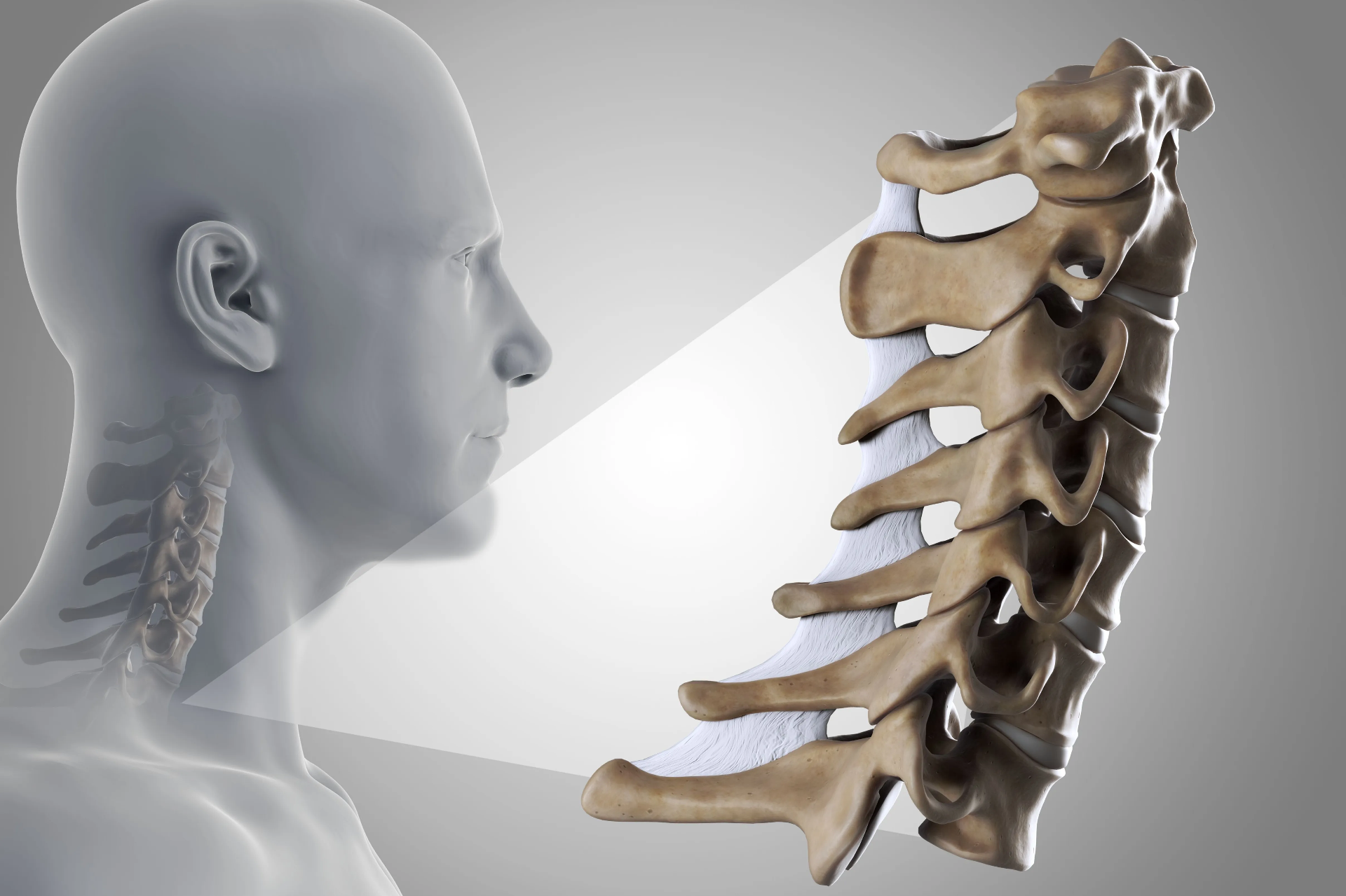 Comprendiendo la radiculopatía cervical