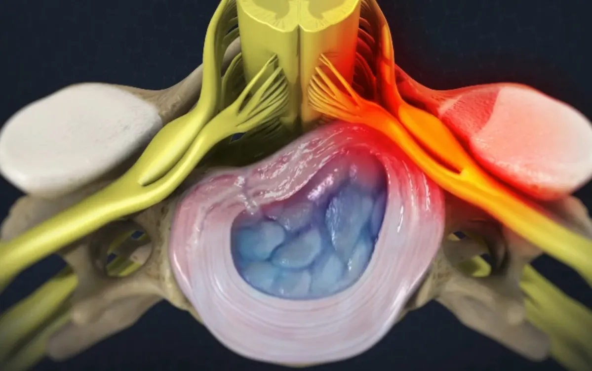 Las causas más comunes de la radiculopatía cervical