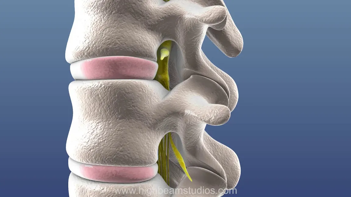 Causas de la radiculopatía lumbar